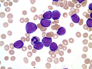 Acute Lymphoblastic Leukemia PB 100x b comp