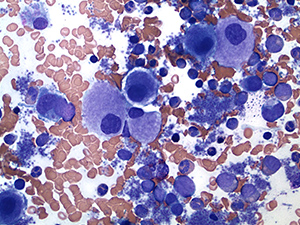 Myeloproliferative neoplasm ASP 50x b comp