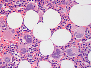 Myeloproliferative neoplasm BM BX 40x 6