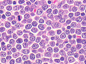 Non-Hodgkin Lymphoma DLBCL 40x