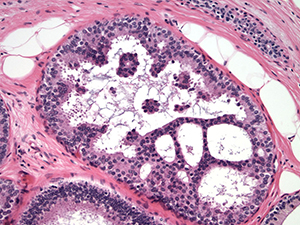 Atypical Ductal Hyperplasia