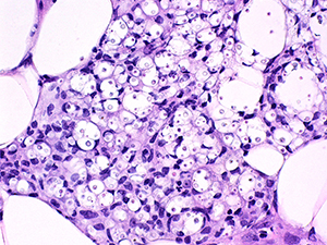 Cryptococcosis subQ 6-4