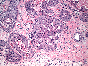 Ductal Carcinoma In Situ