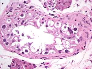 Genitourinary pathology slide