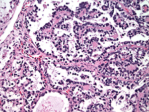 Gynecologic pathology slide