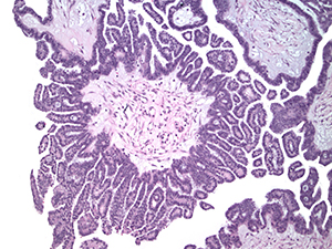 Gynecologic pathology slide