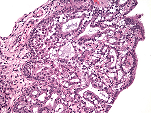 Gynecologic pathology slide