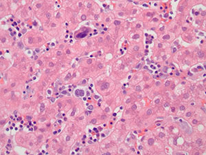 Hepatobiliary pathology slide image