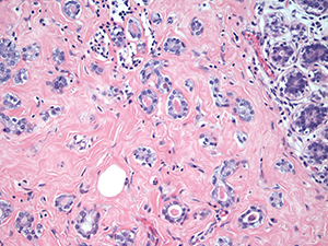 Microglandular Adenosis